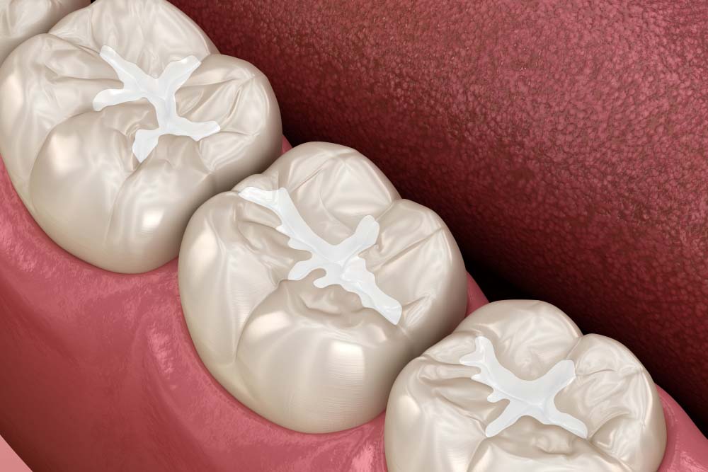 Επικαλύψεις sealants